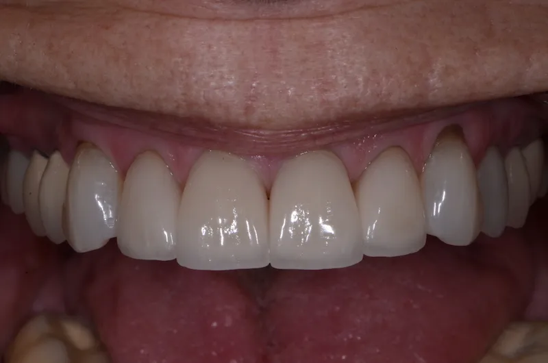 Beautiful smile after veneer placement