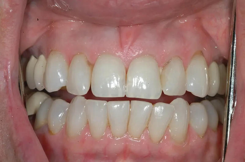 Smile with misshapen teeth