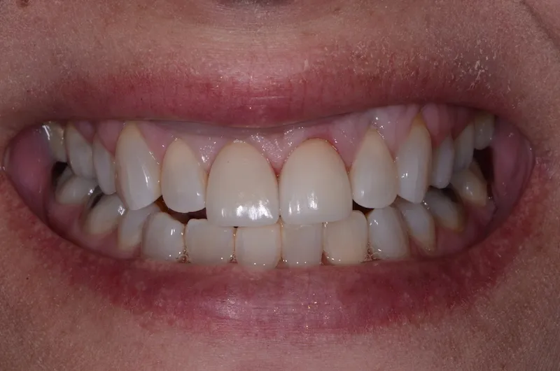 Smile with even front teeth after crown and veneer placement