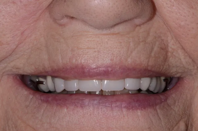 a clean smile completed with a partial denture