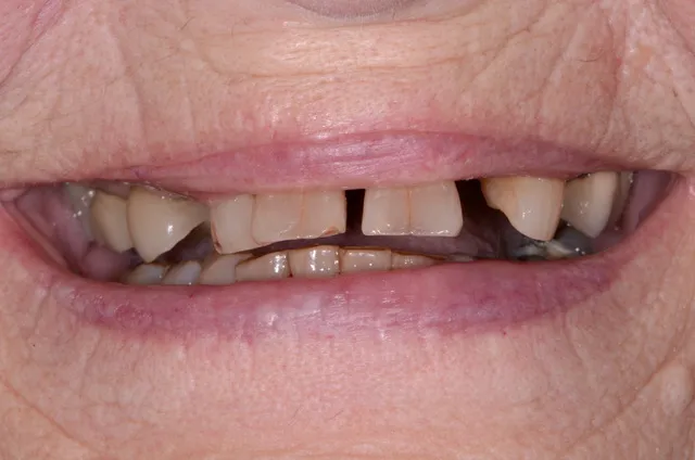 decaying smile with missing and discolored teeth