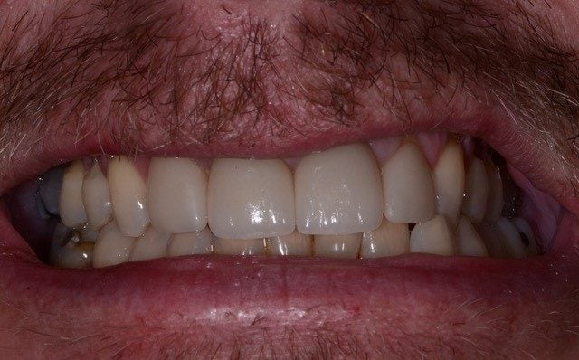 a completed smile with normal front teeth