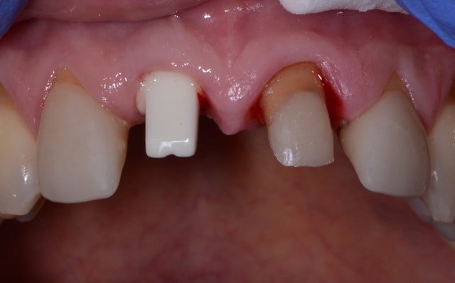 two front teeth that are missing and require supplementing