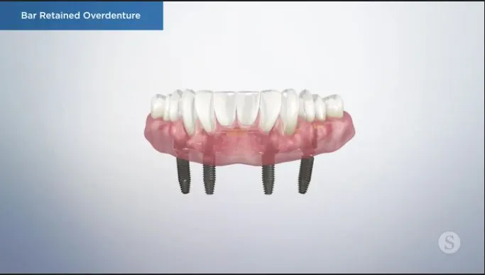 Bar-Retained-Overdenture