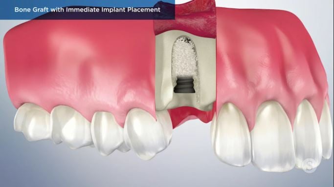 Bone-Graft-with-Immediate-Implant-Placement