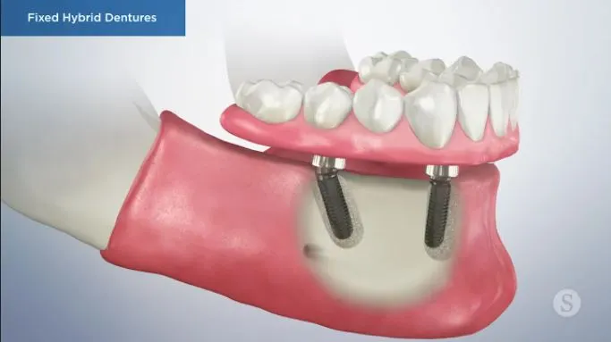 Screw-Retained-Denture