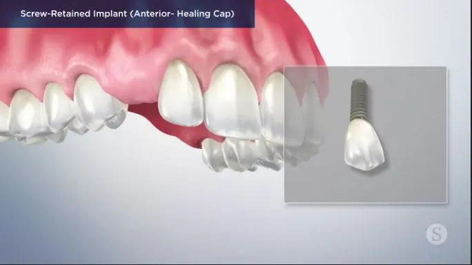 Screw-Retained-Implant-Anterior-Healing-Cap