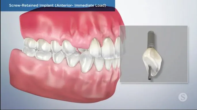 Screw-Retained-Implant-Anterior-Immediate-Load