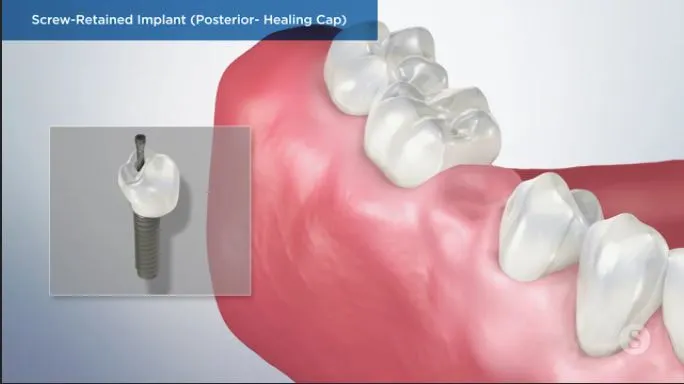 Screw-Retained-Implant-Posterior-Healing-Cap
