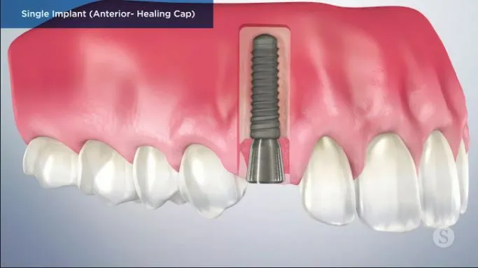 Single-Implant-Anterior-Healing-Cap