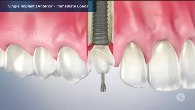 Single-Implant-Anterior-Immediate-Load