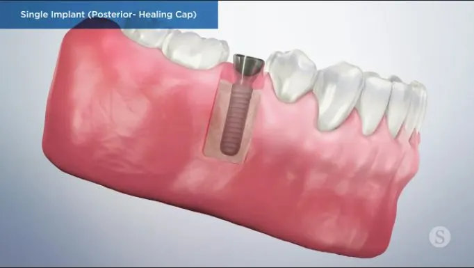 Single-Implant-Posterior-Healing-Cap